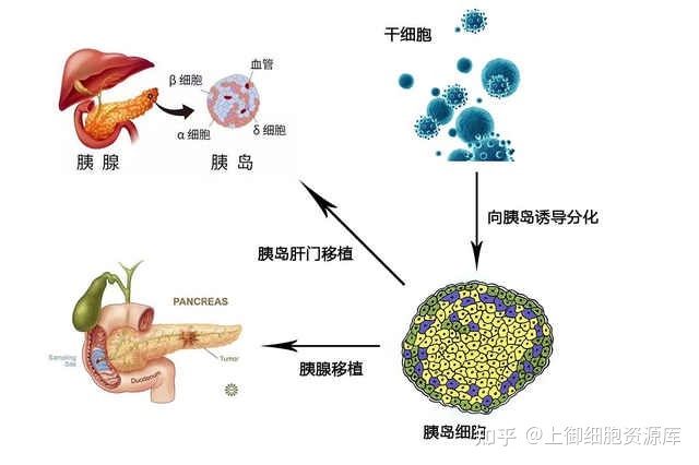 中国约1.3亿人超“甜”了!干细胞移植治疗糖尿病取得最新研究进展!